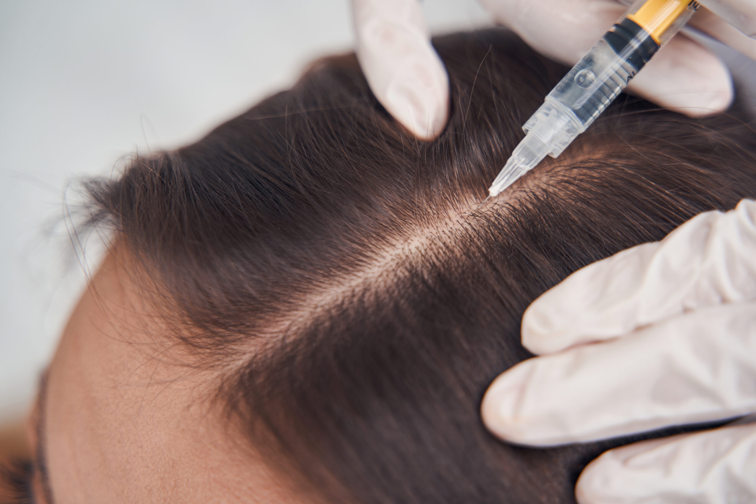 PRP Therapy Hair Restoration Turkey PRP Therapy Hair Restoration Turkey